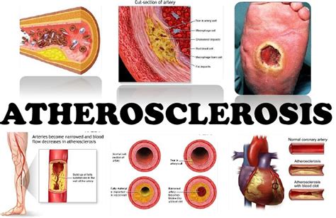 atherosclerotic aorta in tagalog|Arteriosklerosis .